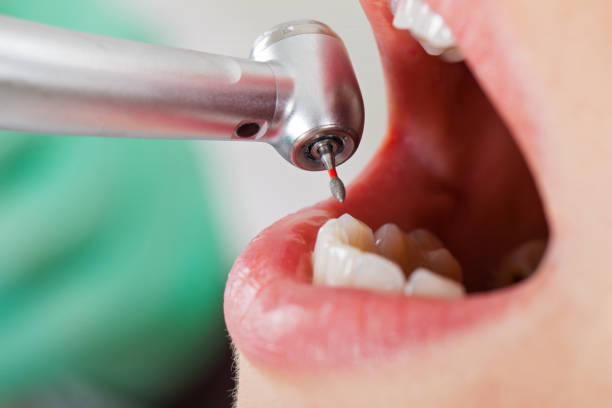 Best Emergency Wisdom Teeth Removal in Lake Hallie, WI